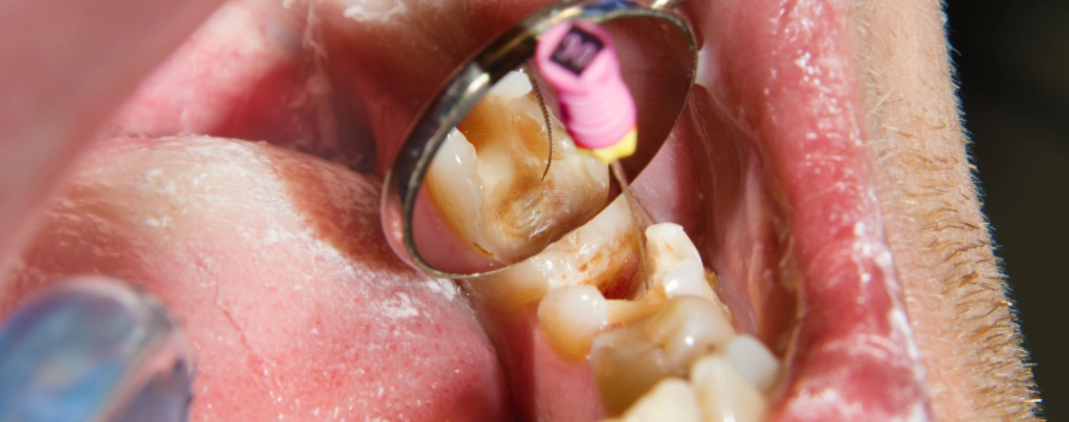 endodontics (1)
