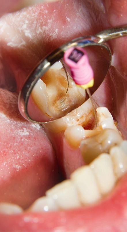 ENDODONTICS (2)